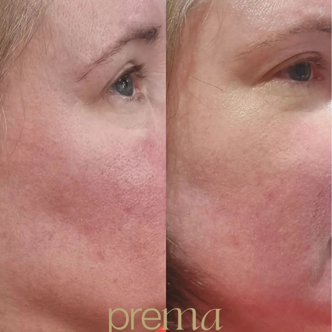 BEFORE AND AFTER ROSACEA TREATMENT SKIN RESURFACING