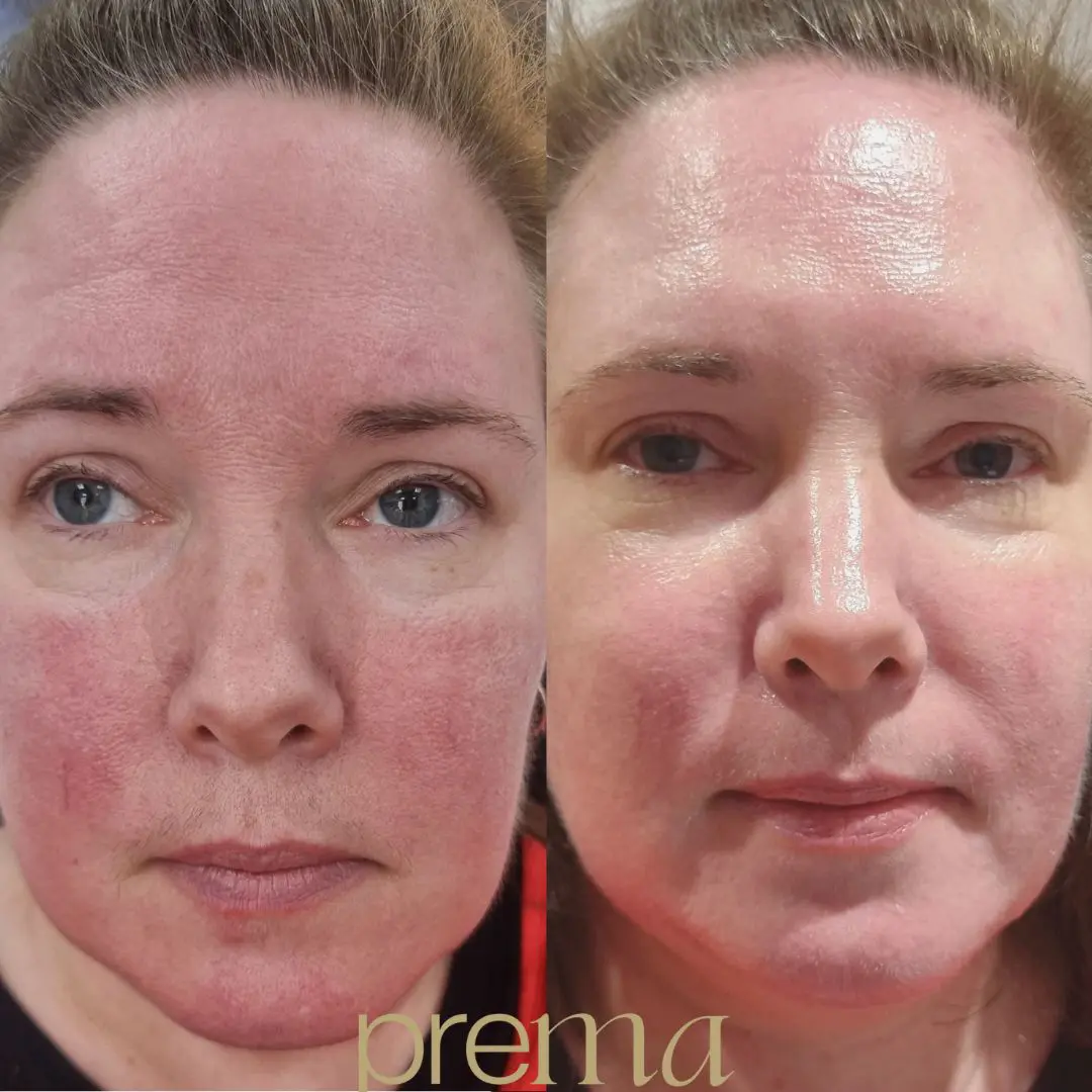 BEFORE AND AFTER IPL ROSACEA