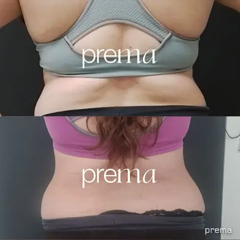 Emsculpt Before & after Prema Clinic