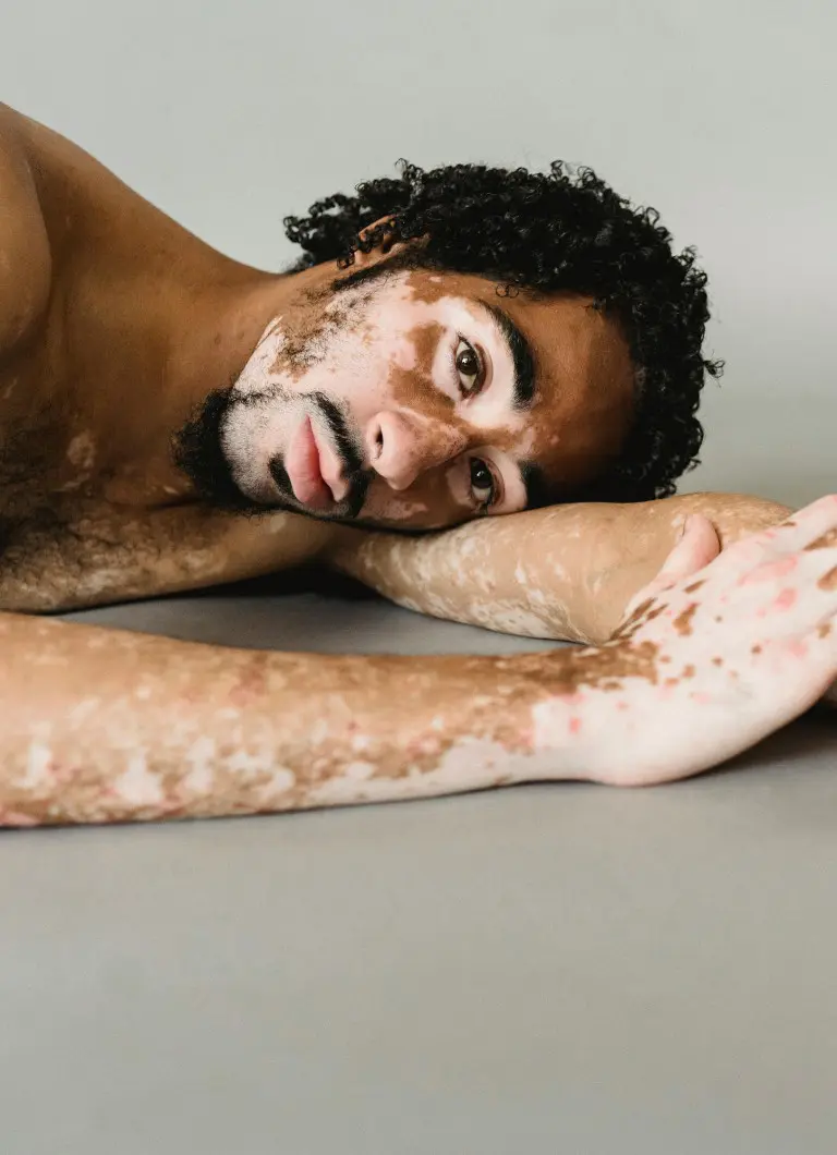 vitiligo treatment portsmouth