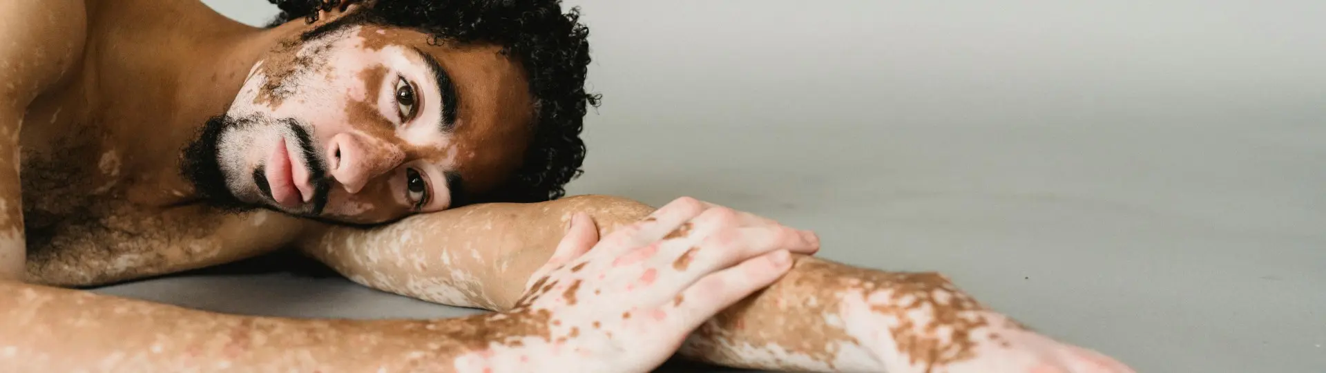 vitiligo treatment hampshire